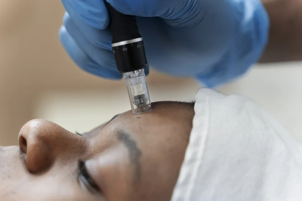 person getting micro needling beauty treatment